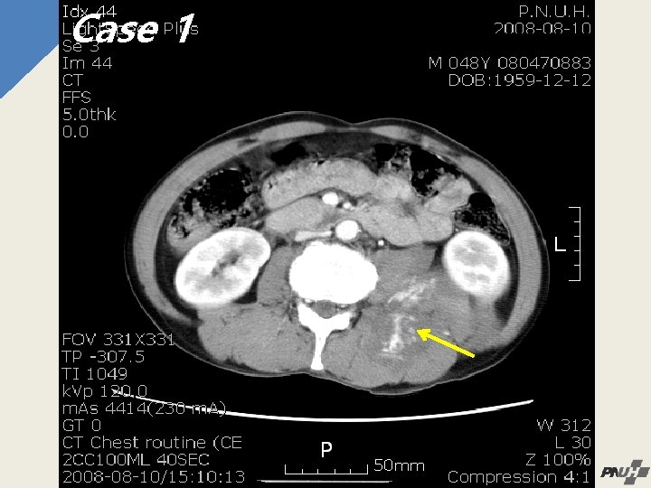 Case 1 