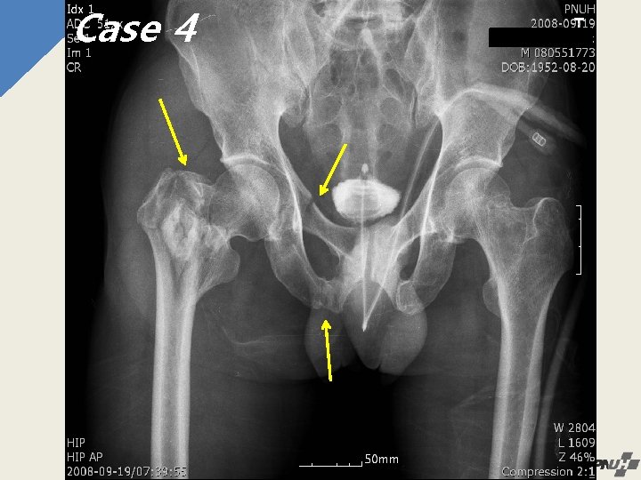 Case 44 4 
