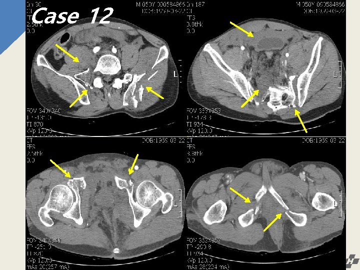 Case 1210 