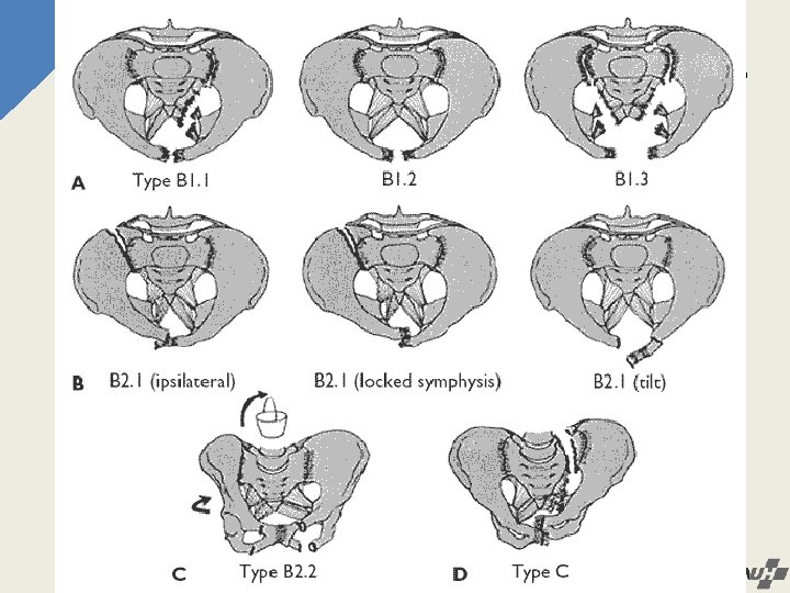 Classification of pelvic bone fracture 1. Tile/AO classification Type A stable fractures Type B