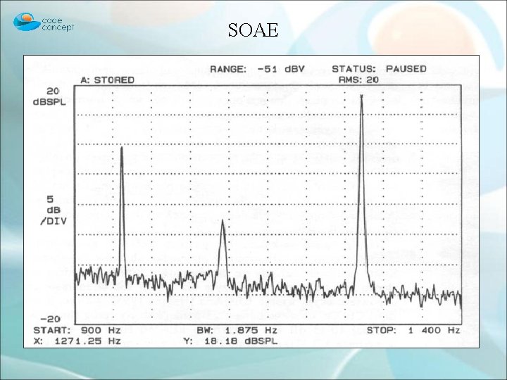 SOAE Ø Spontaniczna – SOAE (spontaneous otoacoustic emissions) • Występuje tylko u 50% normalnie