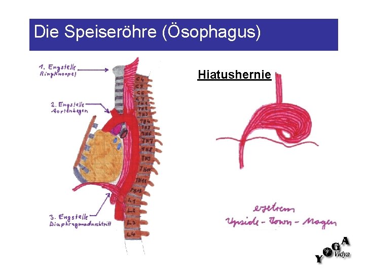 Die Speiseröhre (Ösophagus) Hiatushernie 