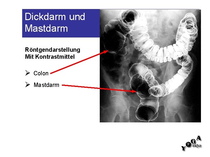 Dickdarm und Mastdarm Röntgendarstellung Mit Kontrastmittel Colon Mastdarm 