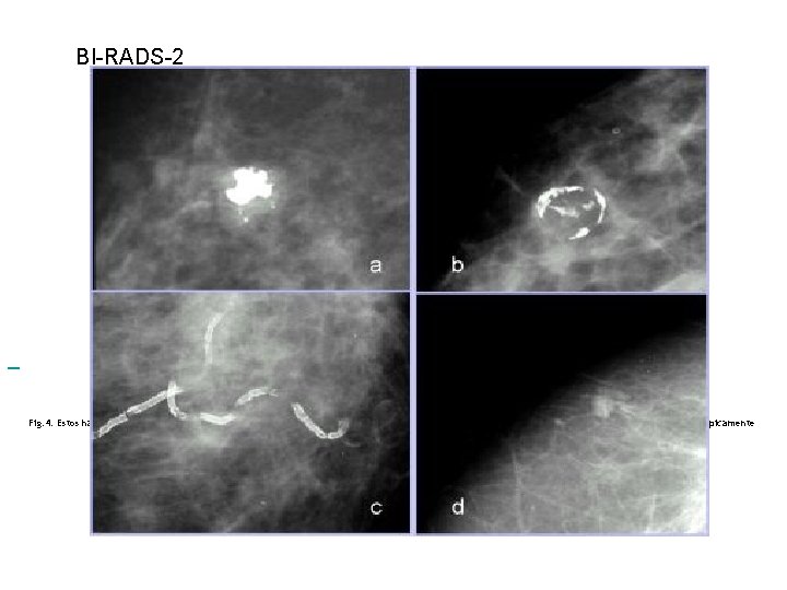 BI-RADS-2 Fig. 4. Estos hallazgos: a y b fibroadenomas parcialmente calcificados, c) calcificaciones vasculares