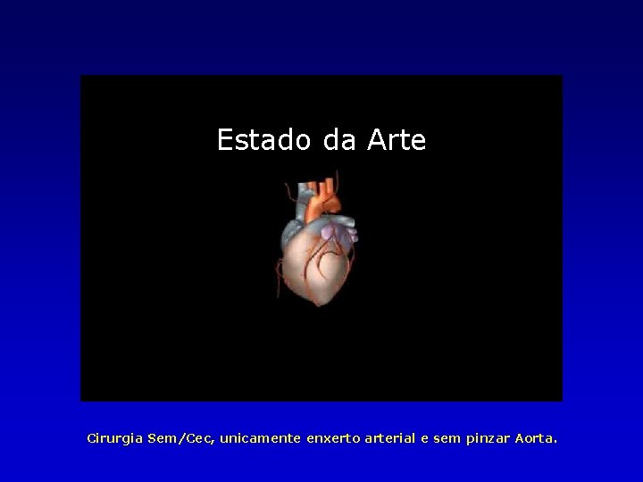 Estado da Arte Cirurgia Sem/Cec, unicamente enxerto arterial e sem pinzar Aorta. 