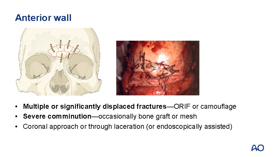Anterior wall • Multiple or significantly displaced fractures—ORIF or camouflage • Severe comminution—occasionally bone