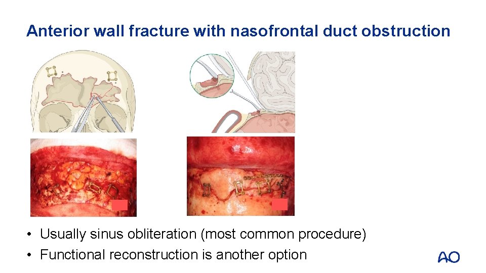 Anterior wall fracture with nasofrontal duct obstruction • Usually sinus obliteration (most common procedure)