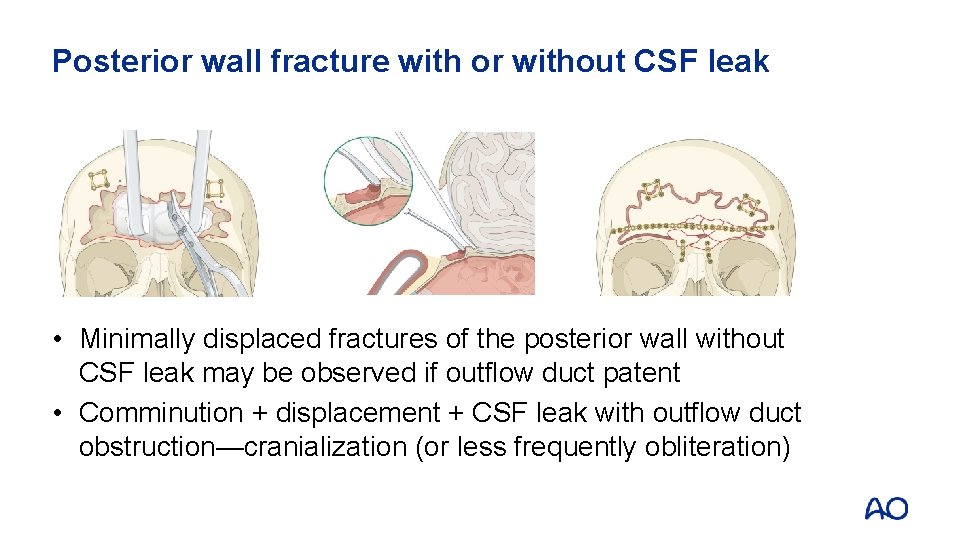 Posterior wall fracture with or without CSF leak • Minimally displaced fractures of the