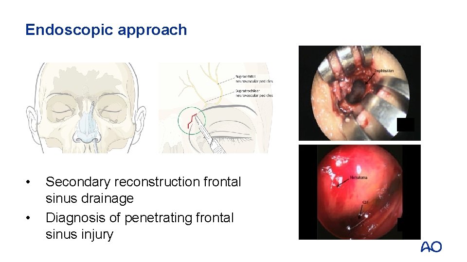 Endoscopic approach • • Secondary reconstruction frontal sinus drainage Diagnosis of penetrating frontal sinus