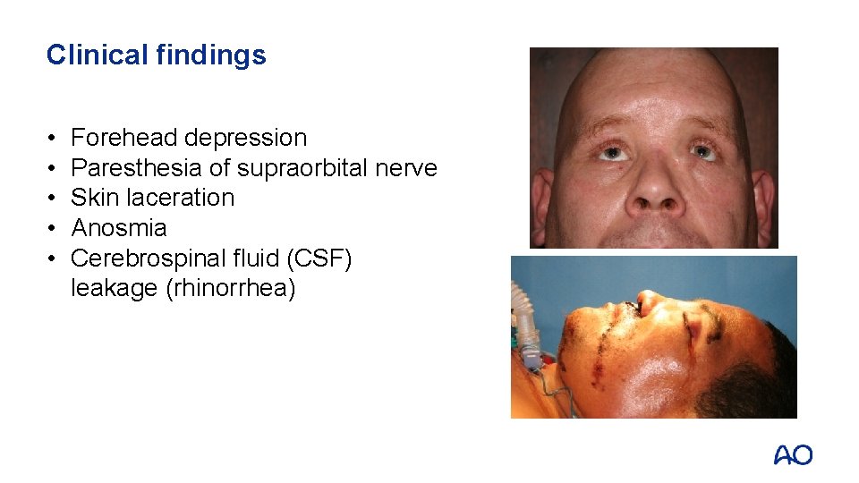 Clinical findings • • • Forehead depression Paresthesia of supraorbital nerve Skin laceration Anosmia