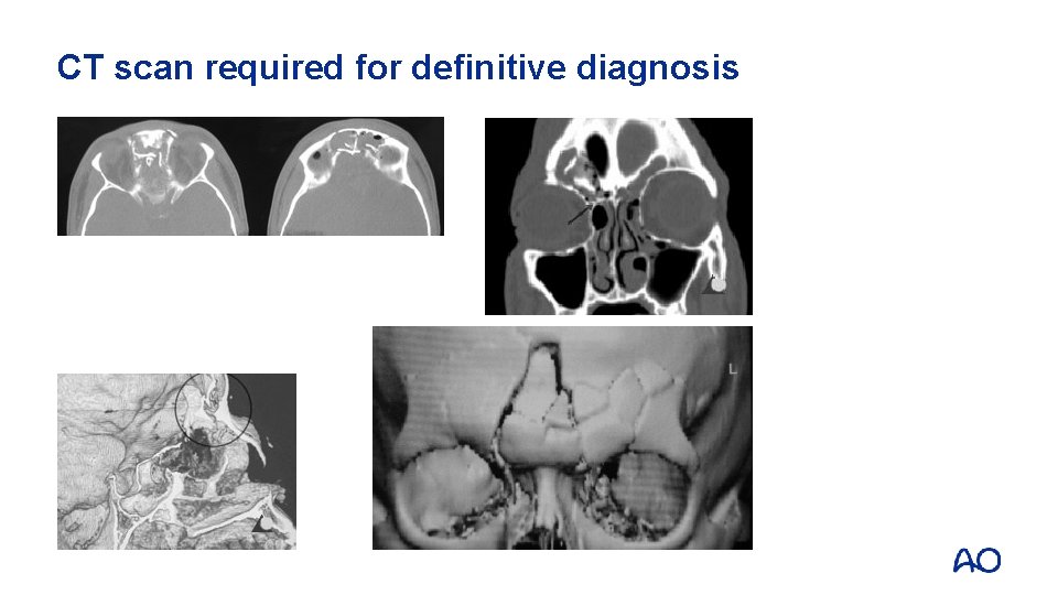 CT scan required for definitive diagnosis 