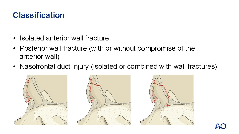 Classification • Isolated anterior wall fracture • Posterior wall fracture (with or without compromise