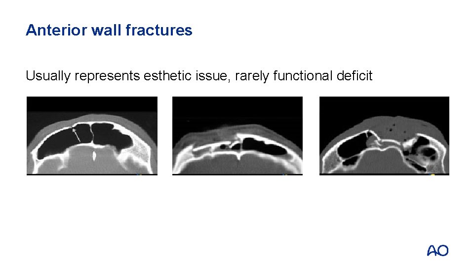 Anterior wall fractures Usually represents esthetic issue, rarely functional deficit 