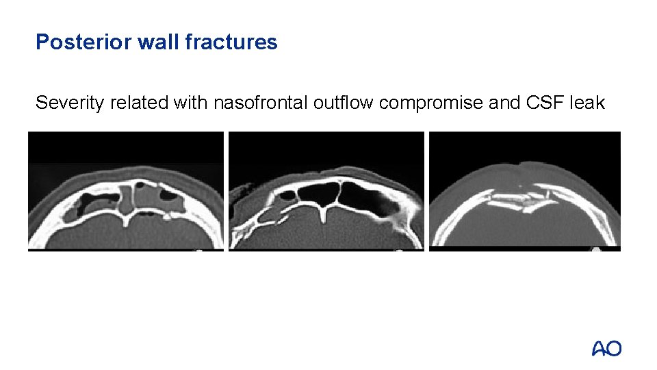 Posterior wall fractures Severity related with nasofrontal outflow compromise and CSF leak 