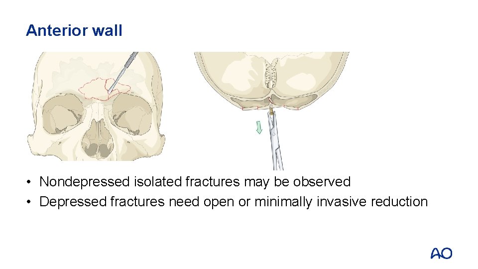 Anterior wall • Nondepressed isolated fractures may be observed • Depressed fractures need open