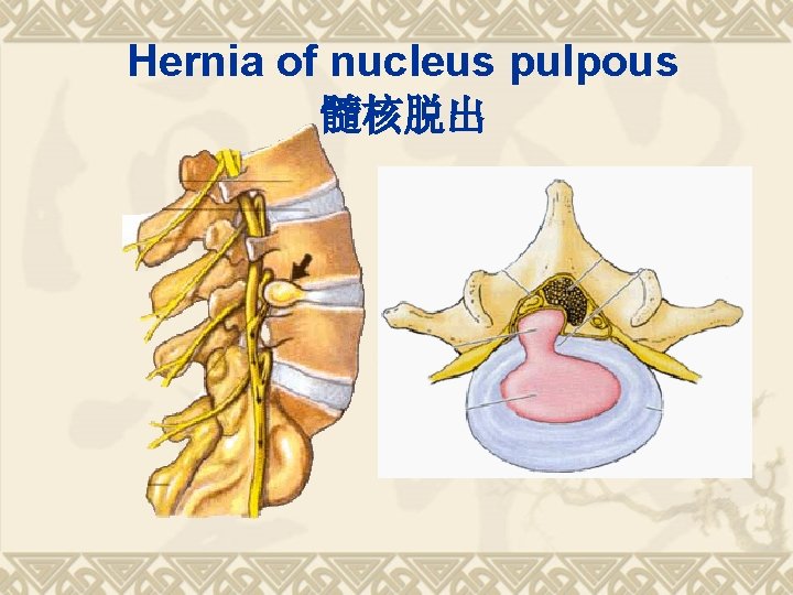 Hernia of nucleus pulpous 髓核脱出 