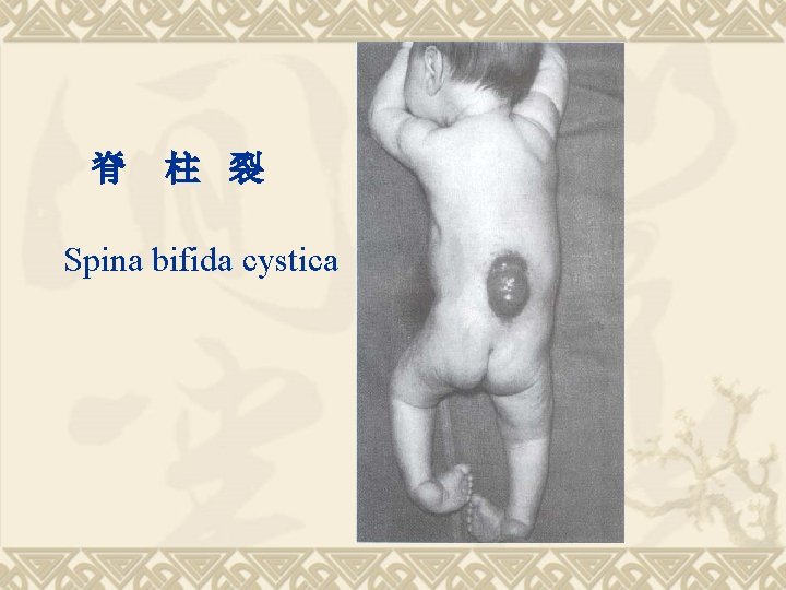 脊 柱 裂 Spina bifida cystica 