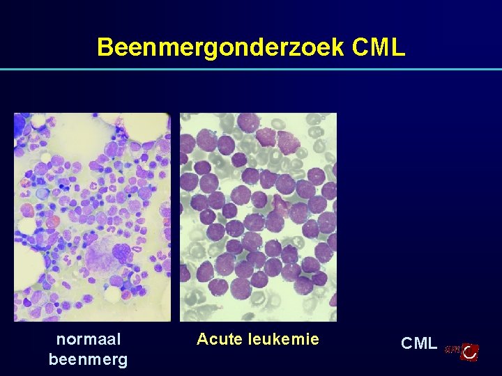 Beenmergonderzoek CML normaal beenmerg Acute leukemie CML 10 