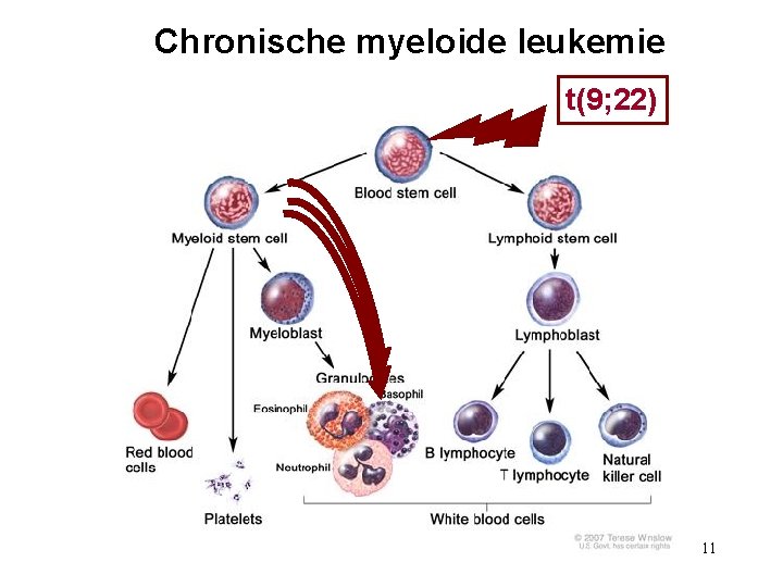 Chronische myeloide leukemie t(9; 22) 11 