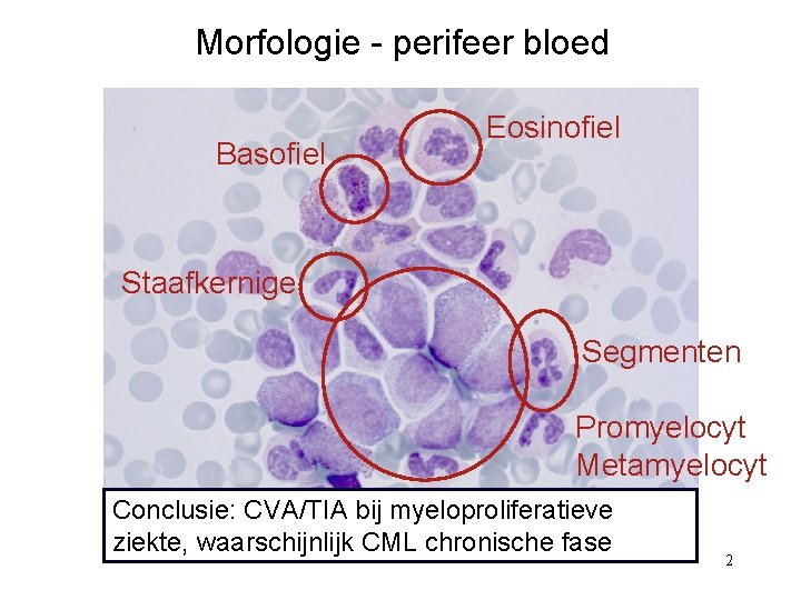 Morfologie - perifeer bloed Basofiel Eosinofiel Staafkernige Segmenten Promyelocyt Metamyelocyt Myelocyt Conclusie: CVA/TIA bij