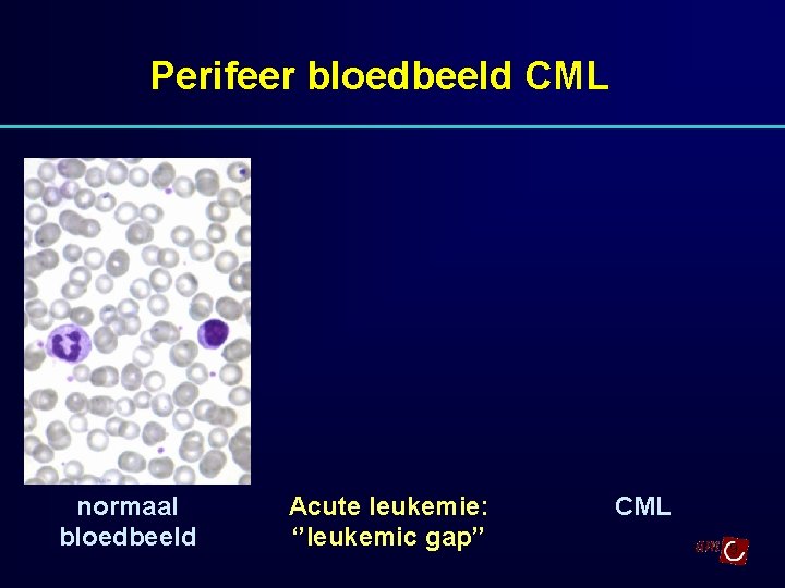 Perifeer bloedbeeld CML normaal bloedbeeld Acute leukemie: ‘’leukemic gap’’ CML 9 