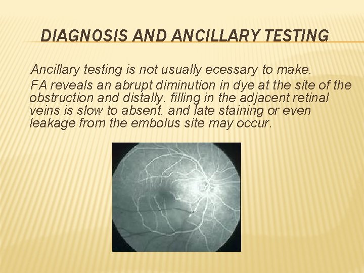 DIAGNOSIS AND ANCILLARY TESTING Ancillary testing is not usually ecessary to make. FA reveals