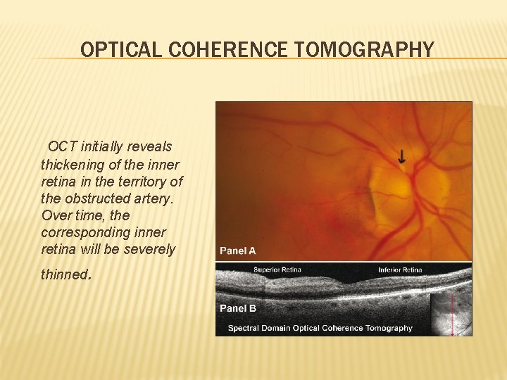 OPTICAL COHERENCE TOMOGRAPHY OCT initially reveals thickening of the inner retina in the territory