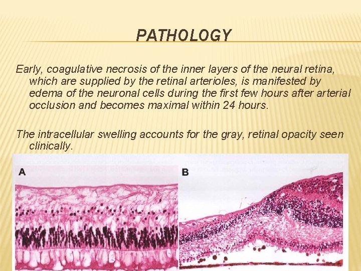 PATHOLOGY Early, coagulative necrosis of the inner layers of the neural retina, which are