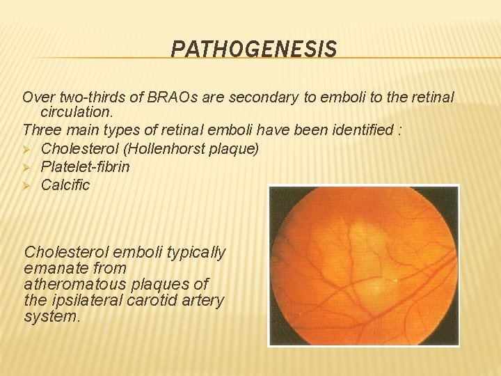 PATHOGENESIS Over two-thirds of BRAOs are secondary to emboli to the retinal circulation. Three