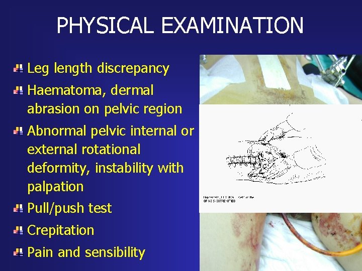 PHYSICAL EXAMINATION Leg length discrepancy Haematoma, dermal abrasion on pelvic region Abnormal pelvic internal