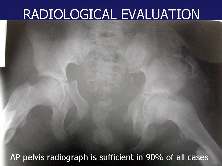RADIOLOGICAL EVALUATION AP pelvis radiograph is sufficient in 90% of all cases 