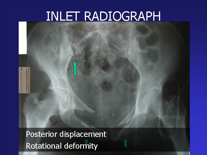 INLET RADIOGRAPH Posterior displacement Rotational deformity 