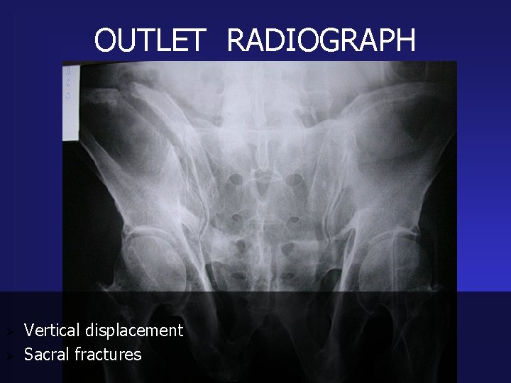 OUTLET RADIOGRAPH Ø Ø Vertical displacement Sacral fractures 