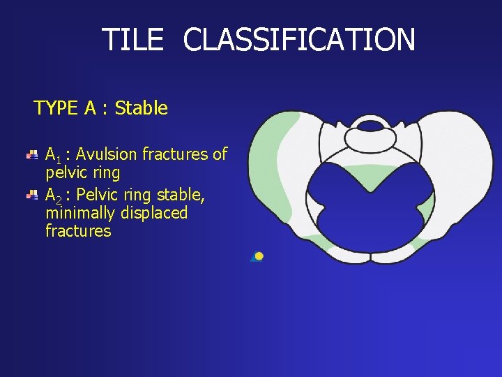TILE CLASSIFICATION TYPE A : Stable A 1 : Avulsion fractures of pelvic ring