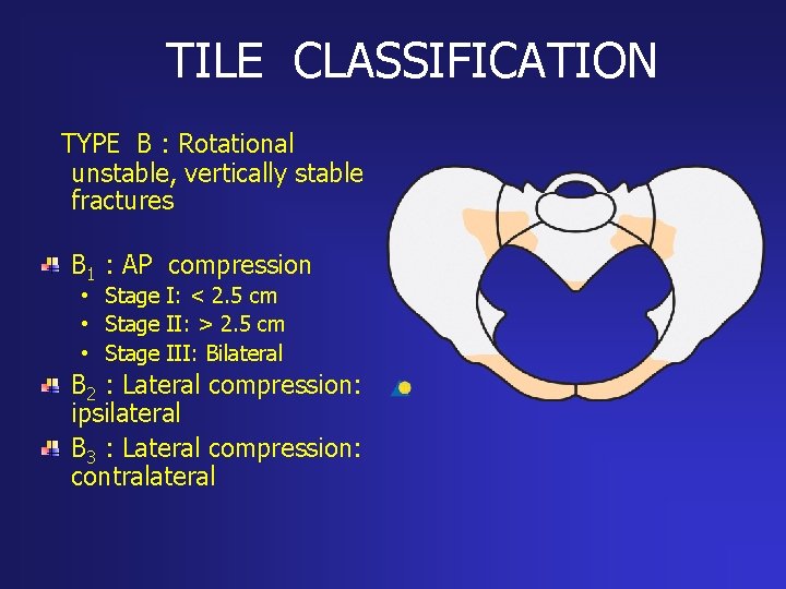 TILE CLASSIFICATION TYPE B : Rotational unstable, vertically stable fractures B 1 : AP