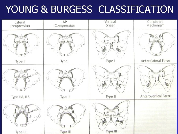 YOUNG & BURGESS CLASSIFICATION 