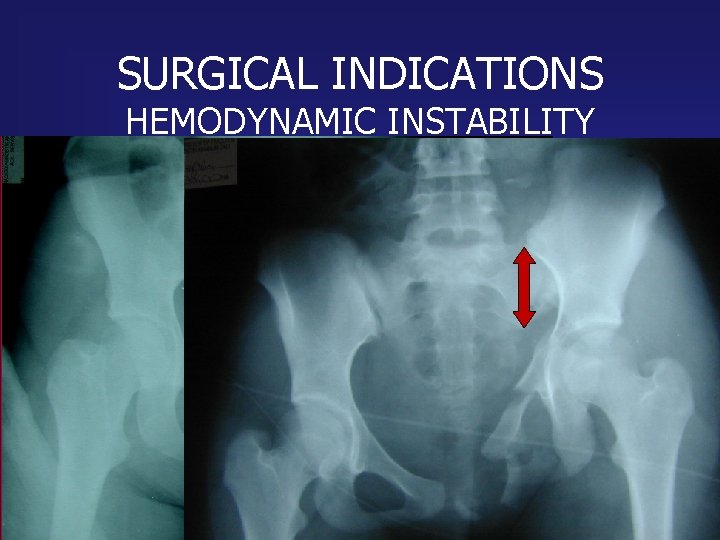 SURGICAL INDICATIONS HEMODYNAMIC INSTABILITY Systolic P < 100 mm Hg Urine < 30 ml/hour