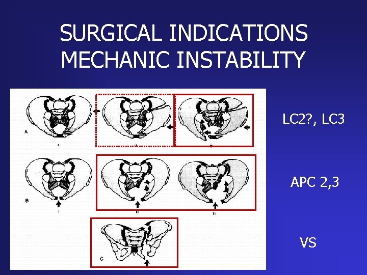 SURGICAL INDICATIONS MECHANIC INSTABILITY LC 2? , LC 3 APC 2, 3 VS 