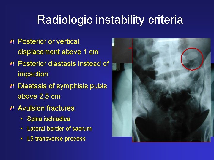 Radiologic instability criteria Posterior or vertical displacement above 1 cm Posterior diastasis instead of