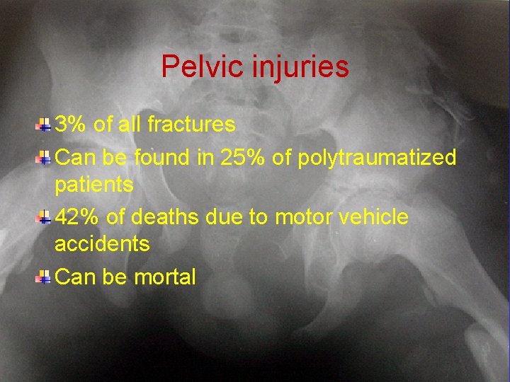 Pelvic injuries 3% of all fractures Can be found in 25% of polytraumatized patients