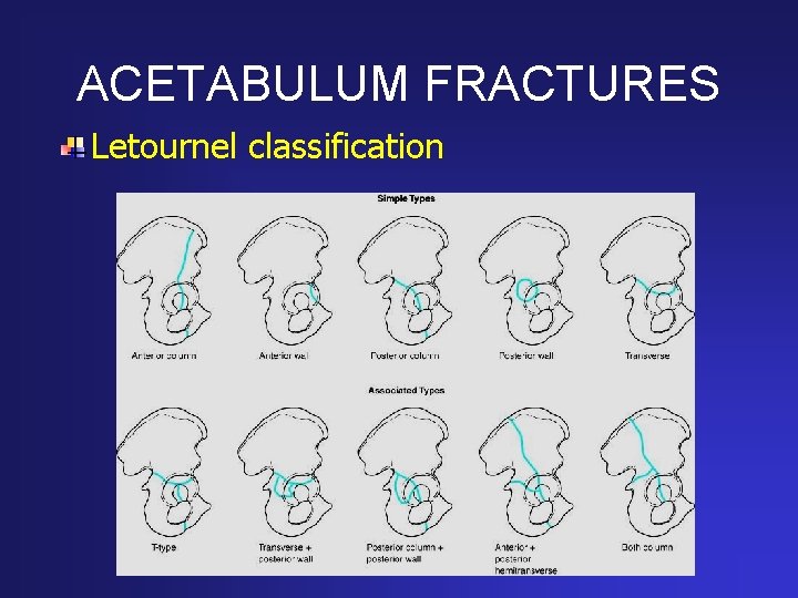 ACETABULUM FRACTURES Letournel classification 