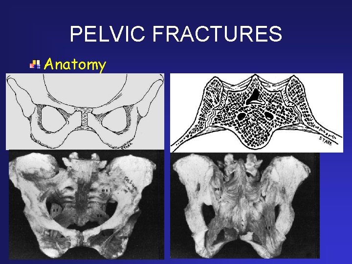 PELVIC FRACTURES Anatomy 