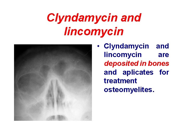 Clyndamycin and lincomycin • Clyndamycin and lincomycin are deposited in bones and aplicates for