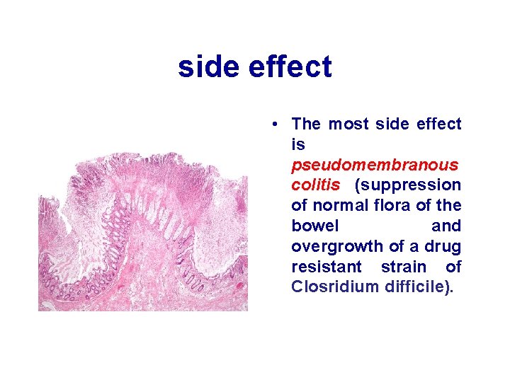 side effect • The most side effect is pseudomembranous colitis (suppression of normal flora