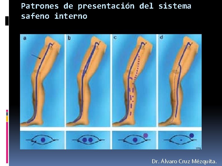Patrones de presentación del sistema safeno interno Dr. Álvaro Cruz Mézquita. 