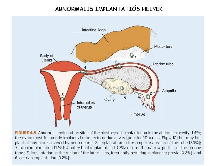 ABNORMALIS IMPLANTATIÓS HELYEK 