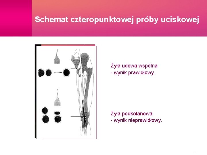 Schemat czteropunktowej próby uciskowej Żyła udowa wspólna - wynik prawidłowy. Żyła podkolanowa - wynik