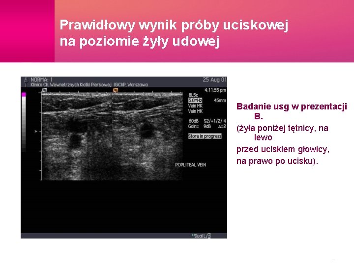 Prawidłowy wynik próby uciskowej na poziomie żyły udowej Badanie usg w prezentacji B. (żyła