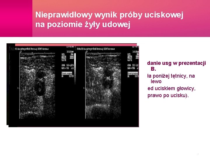 Nieprawidłowy wynik próby uciskowej na poziomie żyły udowej Badanie usg w prezentacji B. (żyła