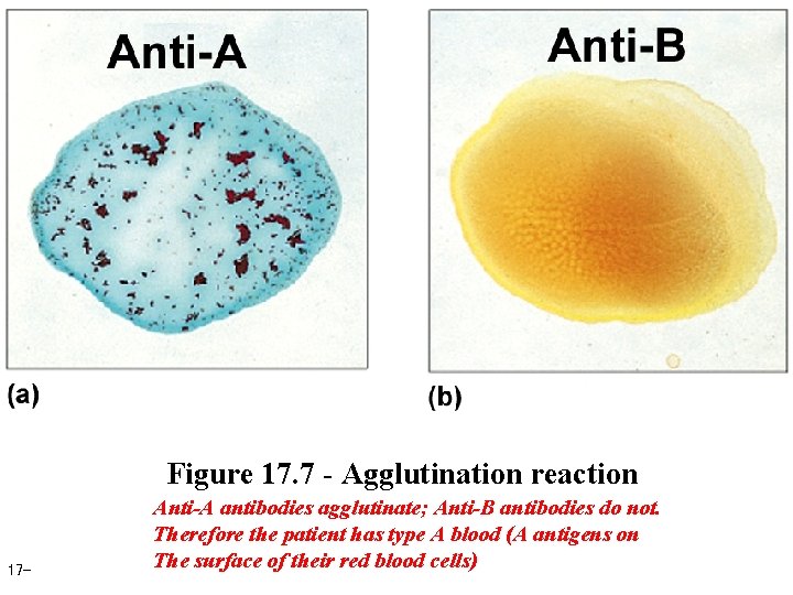 Figure 17. 7 - Agglutination reaction 17 - Anti-A antibodies agglutinate; Anti-B antibodies do